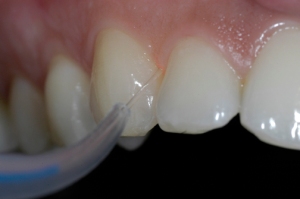 A periodontal procedure performed by a laser