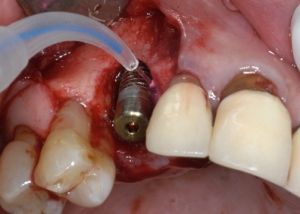 Photosterilization of a compromized dental implant