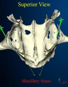 The maxillary sinus on a CT scan 3-D image