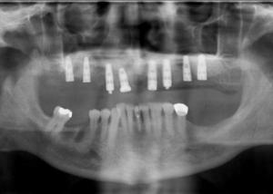 X-ray of 8 implants in the upper jaw