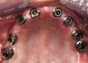 8 implants in the upper jaw with abutments connected